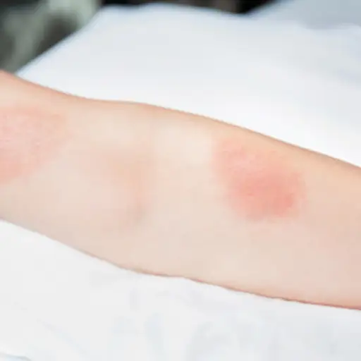 Poison ivy rash on arm.