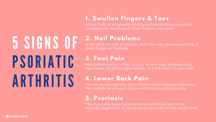 银屑病关节炎的症状包括手指和脚趾肿胀，脚痛，腰痛和银屑病