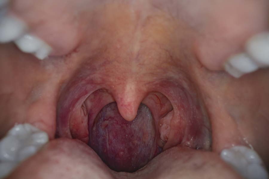 hpv throat cancer prognosis)