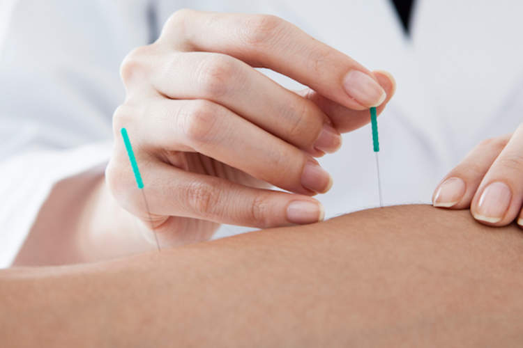 针灸可缓解纤维肌痛?