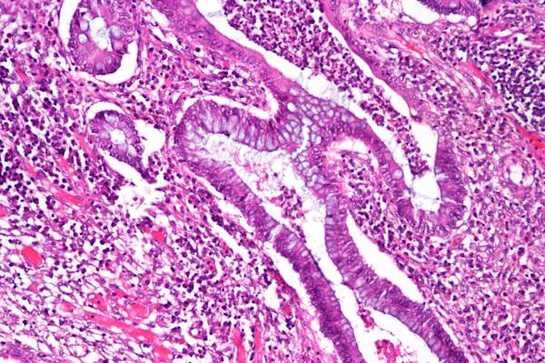 慢性活动性溃疡性结肠炎切除标本的H&E染色