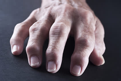 关节炎手指关节的炎症。