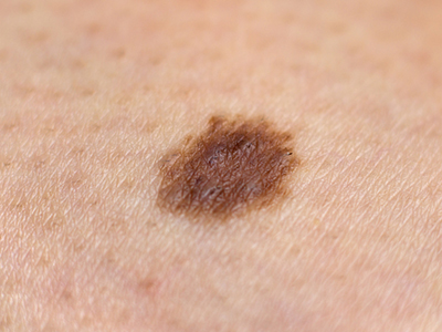 13 Crucial Things Everyone Should Know About Melanoma