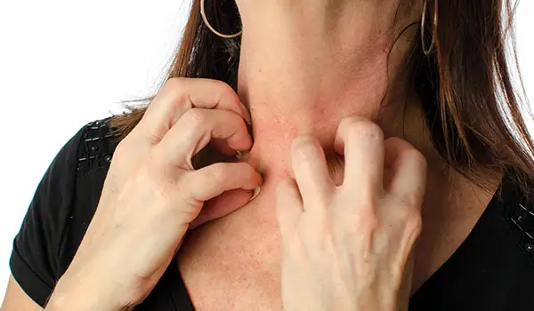 患有湿疹的妇女搔着脖子。