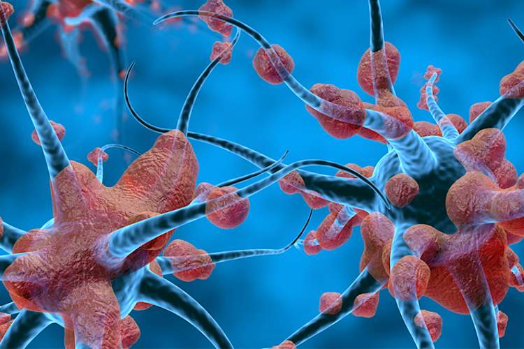 大脑神经细胞中的斑块和缠结。