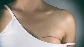 乳房手术疤痕