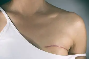 来自乳房手术的疤痕