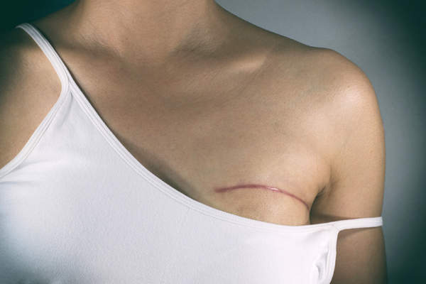 乳房手术疤痕
