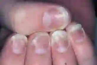 Fingernail psoriasis with onycholysis, pitting, and salmon patches