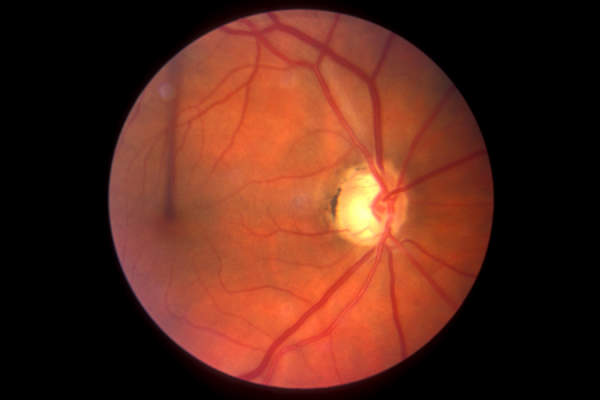 眼睛的视网膜扫描青光眼