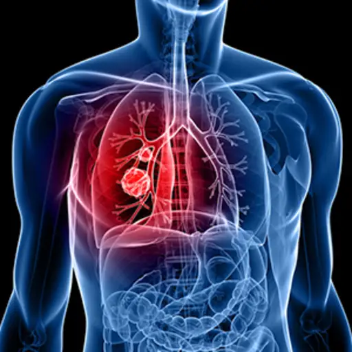 肺癌插图。