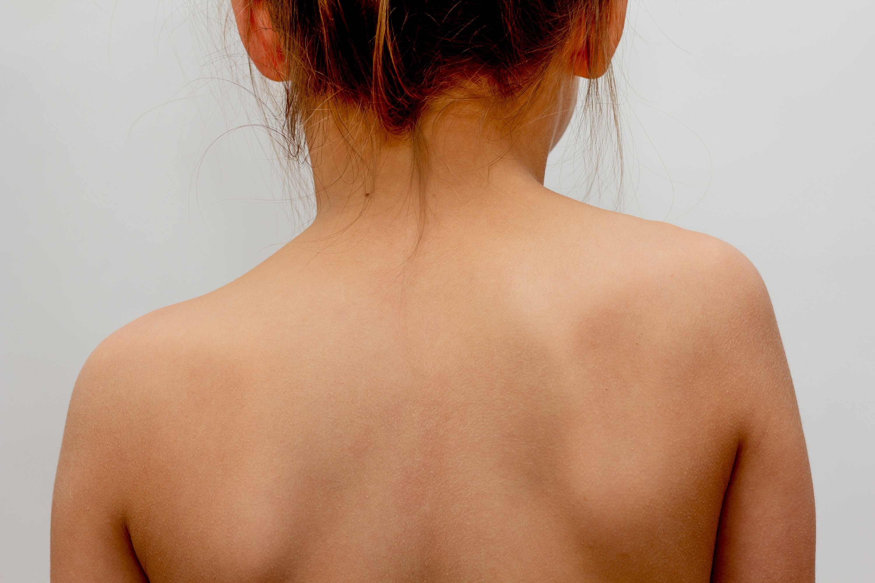 Scoliosis in Rett Syndrome: Causes & Treatment Options
