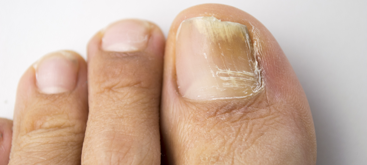 Qian Herbal Foot Cream Nail Fungus Removal Cream Effective Anti Fungal  Infection Onychomycosis Treatment Toe Fungus Repair Feet Care | Fruugo DK