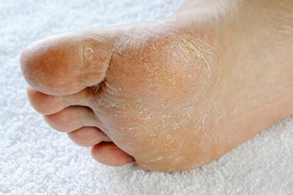 脚底有老茧。