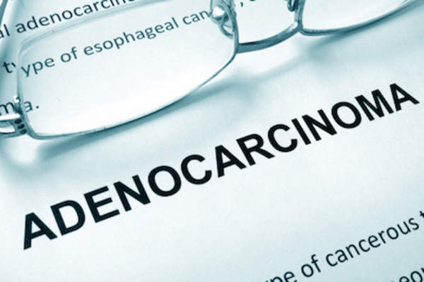 腺癌,人确诊为胃癌90%至95%有这种形式。