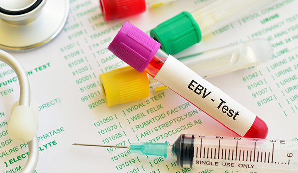 EBV测试。