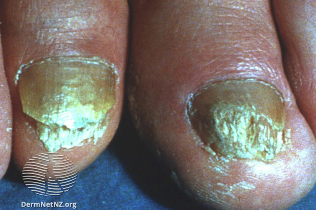 Nail psoriasis causes, symptoms, diagnosis, treatment & prognosis
