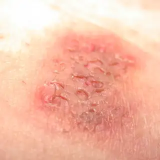 Blackheads on Inner Thigh: Causes and Treatment Options