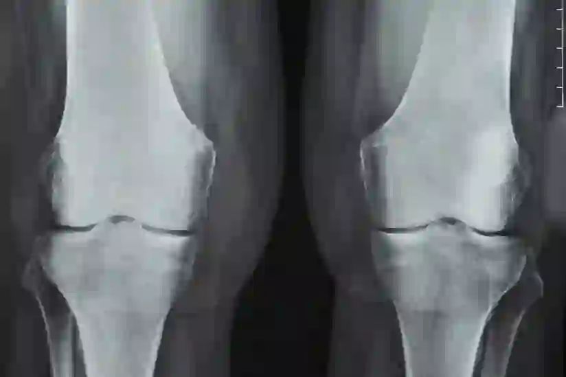x射线类风湿性关节炎的膝盖