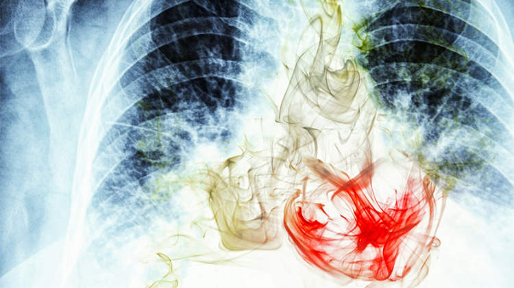 x光片中烟雾对心脏和肺的影响。