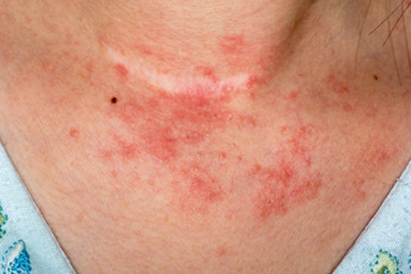 颈部皮肤湿疹。