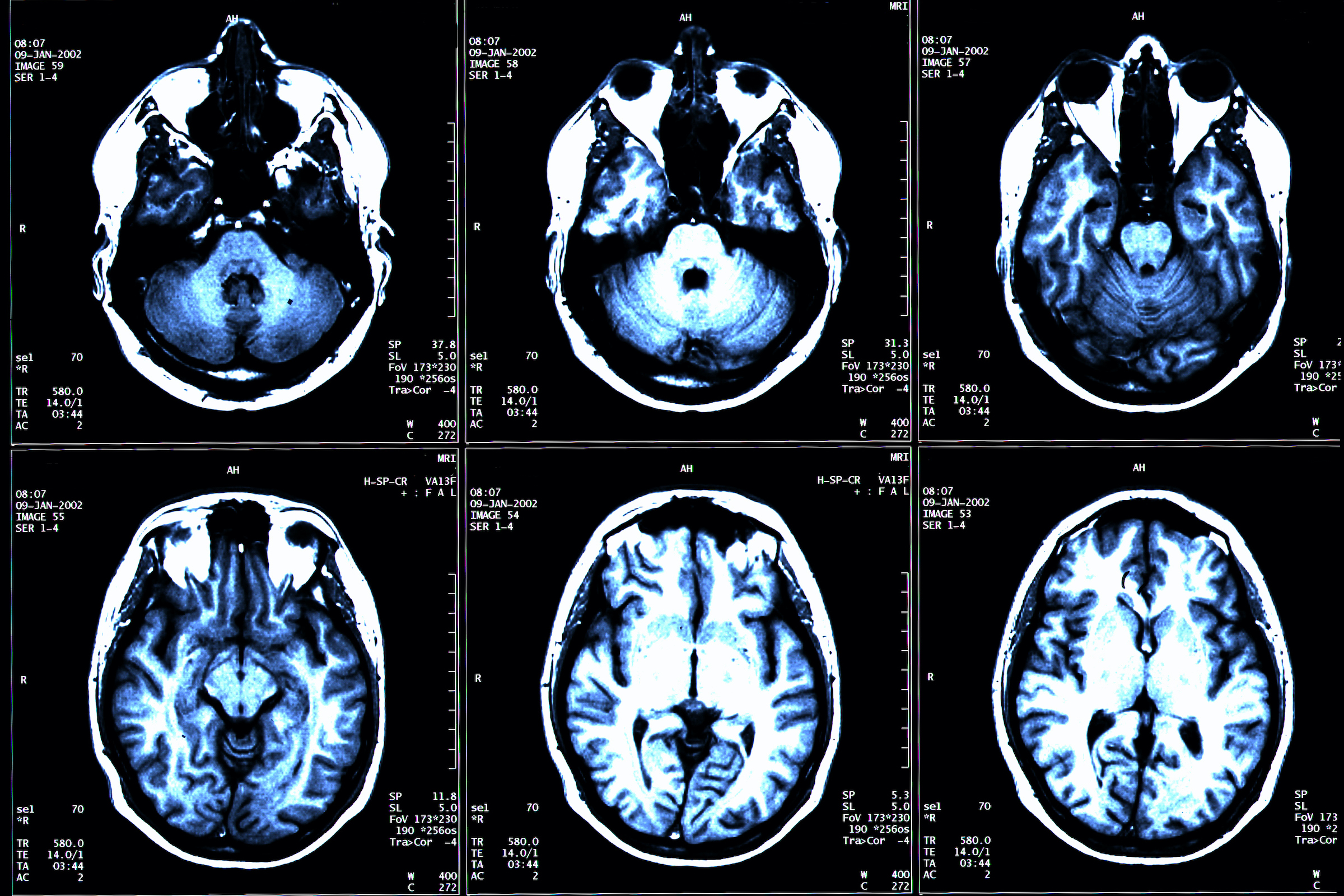 MS Brain Lesions and Their Effects