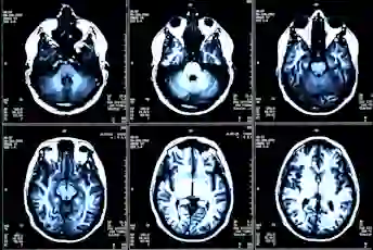 多发性硬化症MRI