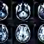 multiple sclerosis MRI