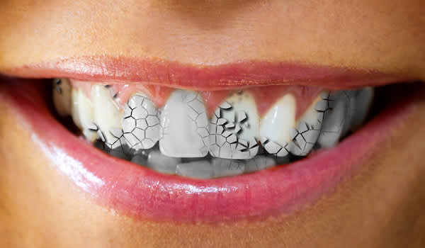 胃酸倒流会破坏牙釉质。