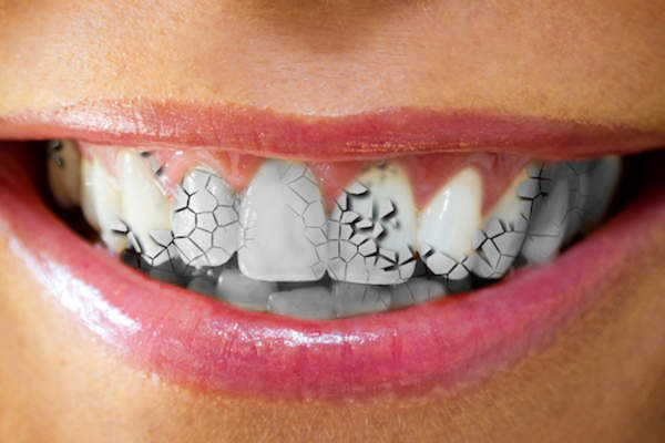 胃酸倒流会破坏牙釉质。