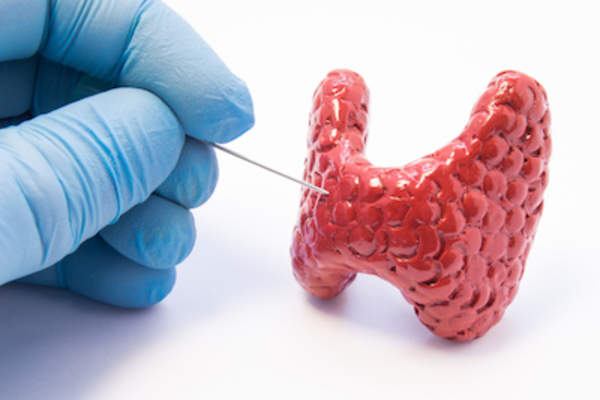 淋巴结活检的概念。