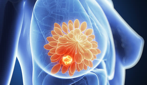 肿瘤中示出的乳房