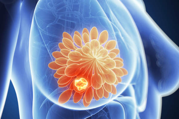 肿瘤中示出的乳房