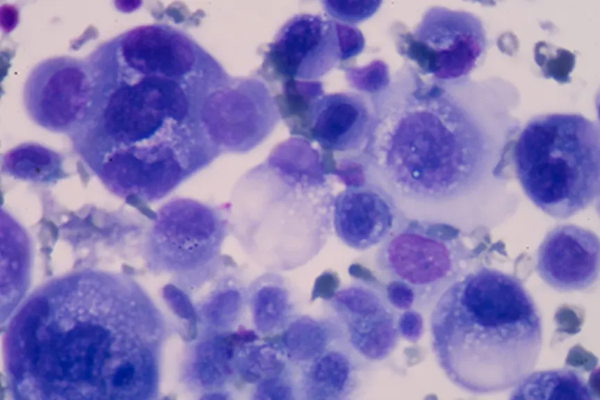 人类的癌细胞显示出异常细胞