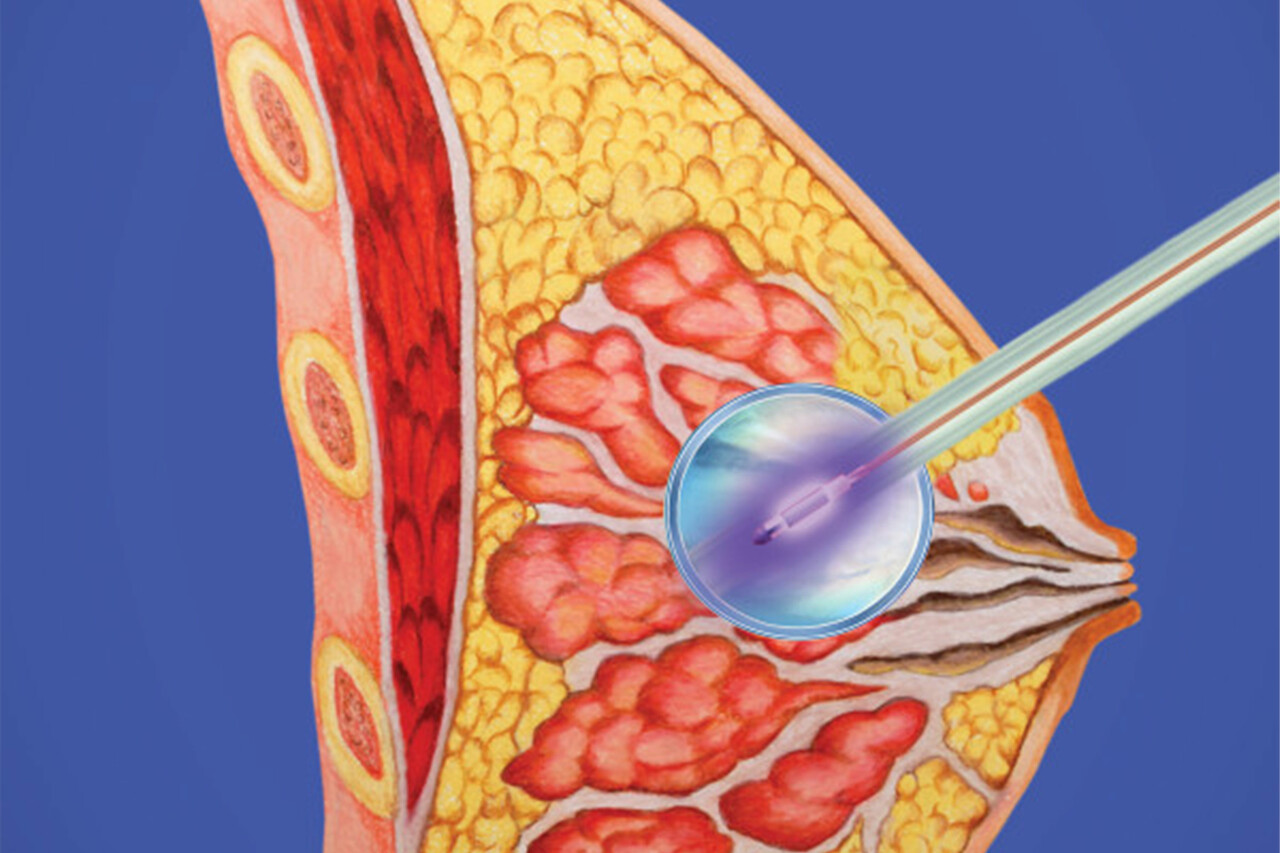 Brachytherapy for Breast Cancer: What Is It and When Is It Used?