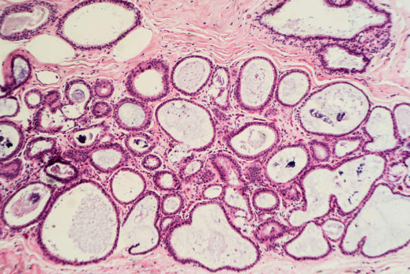 显微镜下在乳房纤维囊性变化