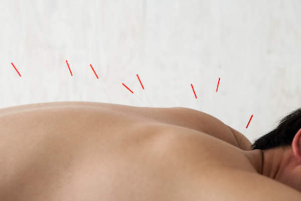 男子接受针灸治疗。