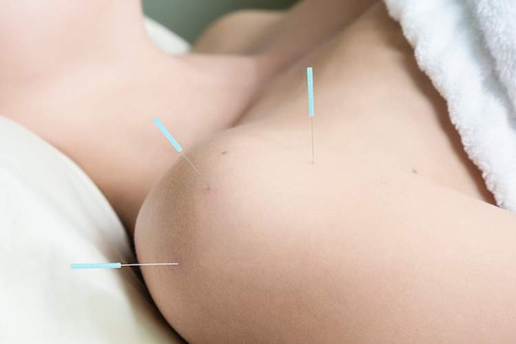 女子因关节痛在肩膀上针灸。