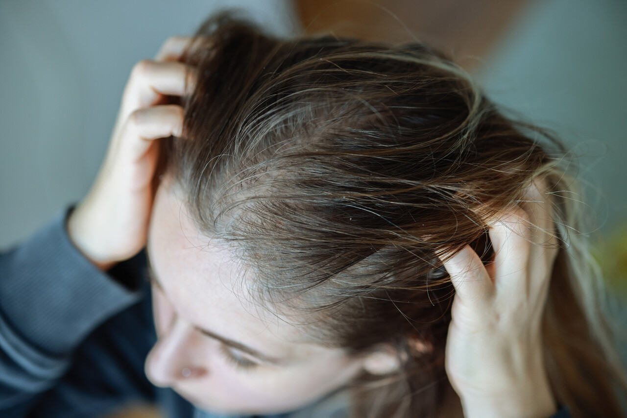 Top Tips for Exercising With Scalp Psoriasis