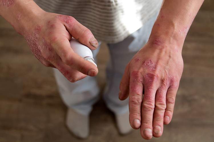 psoriasis medication spray