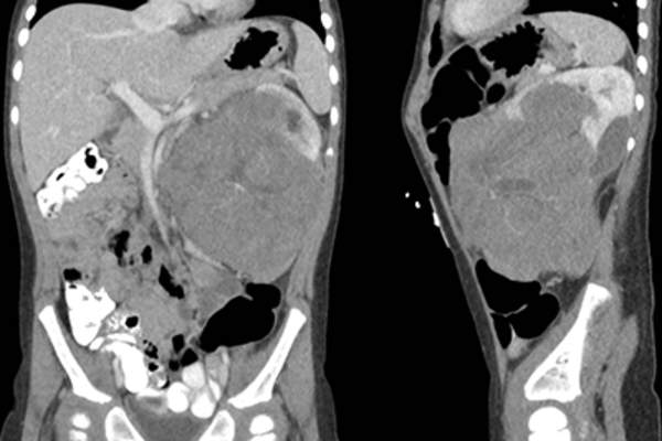 肾母细胞瘤显像。
