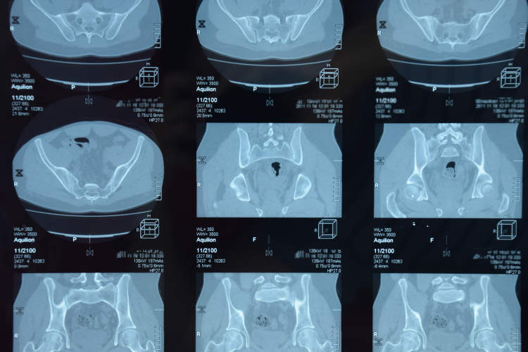 强直性脊柱炎患者的MRI