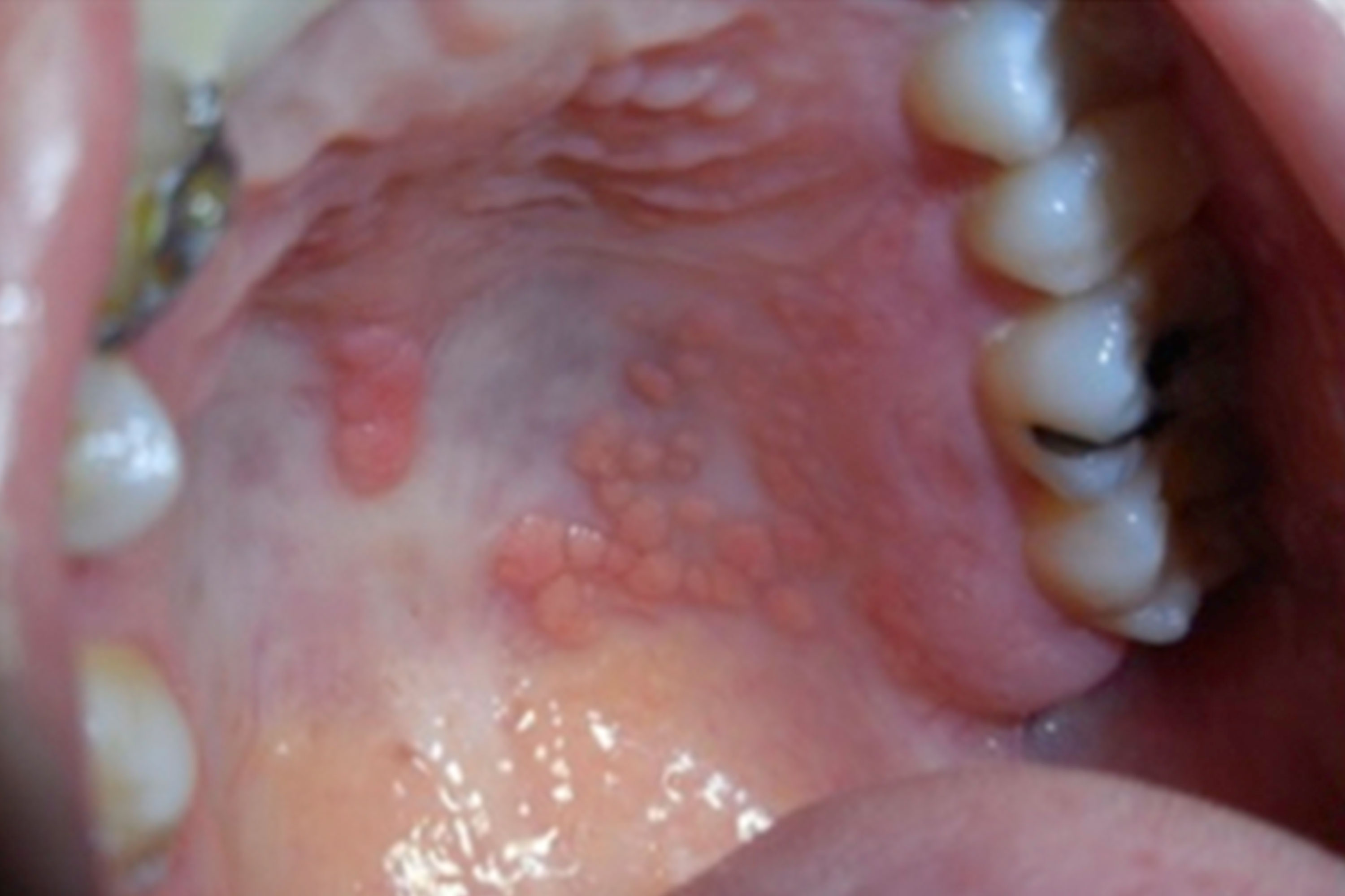 What Are Cholesterol Deposits?, image size:3000x2000