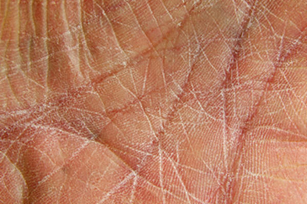 干性皮肤的手掌。