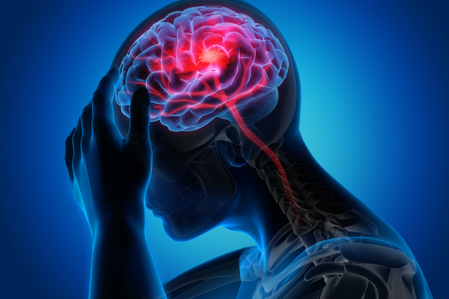 Stroke Signs, Symptoms, Causes, and Treatments