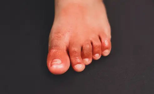 Rheumatoid Arthritis (RA) in Feet: Symptoms, Treatment