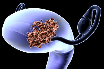 子宫内膜癌细胞。