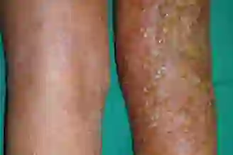 A view of infected eczema on the backs of a person's knees