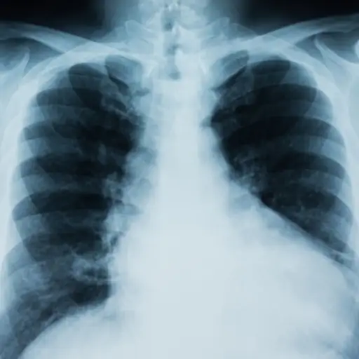 肺X射线