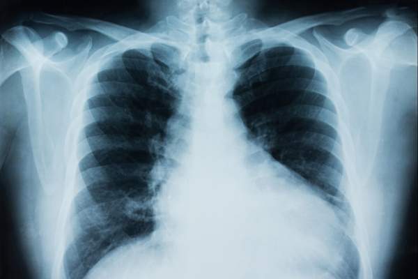 Lung x-ray